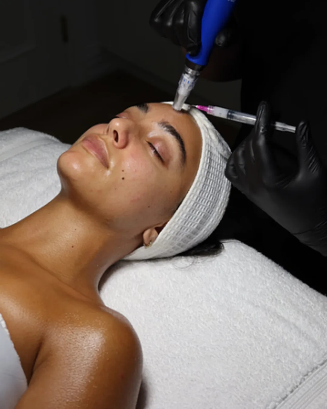 Microneedling Treatment